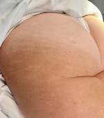 before buttocks microneedling 