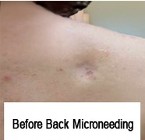 Before Back Microneedling