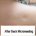 After Back Microneedling