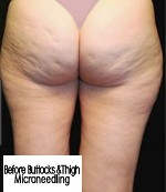 before Buttocks & thigh Microneedling
