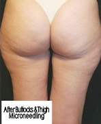 After Buttocks & thigh Microneedling
