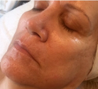 After Biolight & Microneedling Treatment