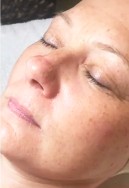 after before hydro luxe rejuvenating facial