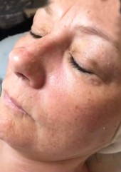 before hydro luxe rejuvenating facial