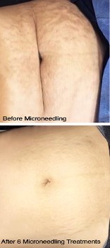 Stomach Microneedling Before/After