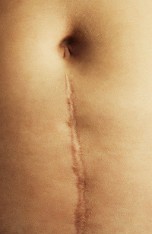 Cesarean Scar Microneedling 