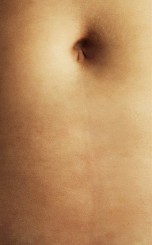 Cesarean Scar Microneedling after