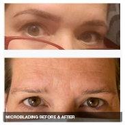 Before & After of HD Microblading