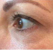 After Eye Lift 