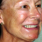Full Face Plasma Lift