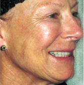 After Full Face Plasma Lift