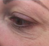 Before Eye Lift