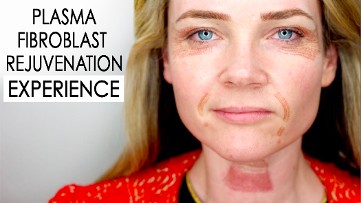 Plasma Face Lift Rejuvention Experience