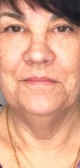 Before Jowel & Throat Plasma