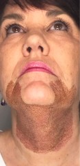 After Jowel & Throat Plasma