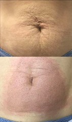 Before/After Stomach Plasma Treatment