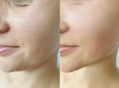 Mesenchymal Stem Cell Face  & Neck Lift 