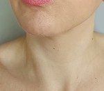 neck only view of after mesenchymal stem cell neck lift 