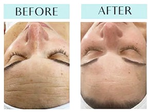 Hydra Dew Pure Facial Before & After Hydra Dew Pure Facial Before & After