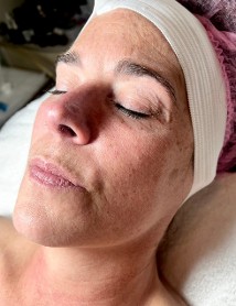 Before Mesenchymal Stem Cell Therapy