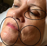 Before 3 Sessions of Face & Throat Botanical Stem Cell Therapy