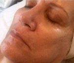 Botanical Stem Cell Therapy (After)