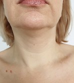 Before Mesenchymal Throat Treatment
