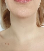 After mesenchymal stem cell throat lift 